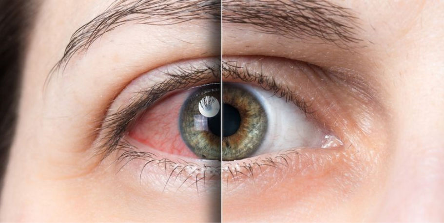 Before and after image of dry eye treatment: eye on left is red and sore, eye on right is white and clear